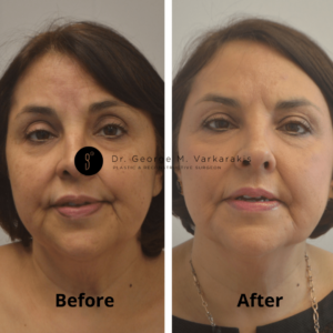 Before and After Fat Grafting 2