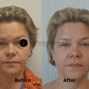 fat transfer
