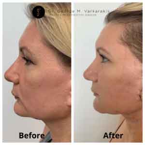 Before and After Facelift - 3 days Post Op - other side view